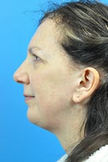 Chin Implant Before and After Pictures Indianapolis, IN