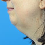 Chin Implant Before and After Pictures Indianapolis, IN