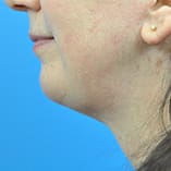 Chin Implant Before and After Pictures Indianapolis, IN