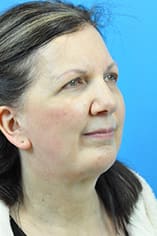 Chin Implant Before and After Pictures Indianapolis, IN