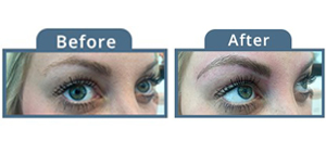 Brow Lift Before and After Pictures Indianapolis, IN
