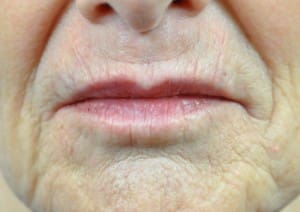 Volbella Before &amp; After Pictures in Indianapolis, IN ...