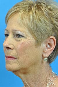 Facelift Before and After Pictures Indianapolis, IN