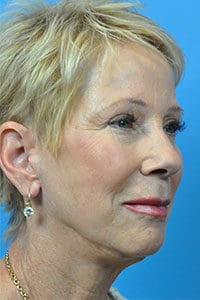Facelift Before and After Pictures Indianapolis, IN