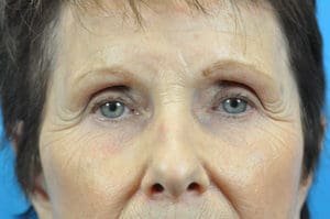Facelift Before and After Pictures Indianapolis, IN