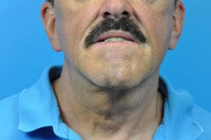 Facelift Before and After Pictures Indianapolis, IN