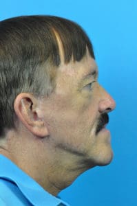 Facelift Before and After Pictures Indianapolis, IN