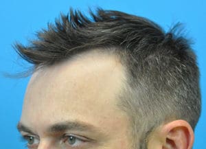 Hair Transplant Before and After Pictures Indianapolis, IN
