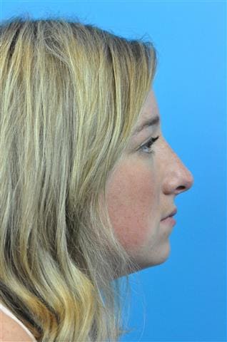 Rhinoplasty Before and After Pictures Indianapolis, IN