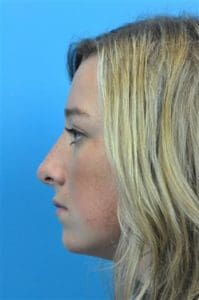 Rhinoplasty Before and After Pictures Indianapolis, IN