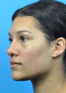 Rhinoplasty Before and After Pictures Indianapolis, IN