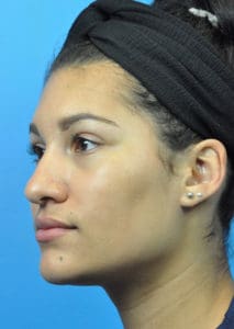 Rhinoplasty Before and After Pictures Indianapolis, IN
