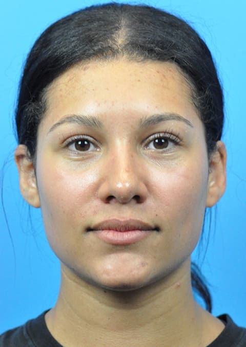 Rhinoplasty Before and After Pictures Indianapolis, IN