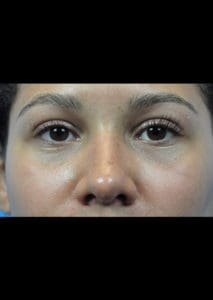 Rhinoplasty Before and After Pictures Indianapolis, IN