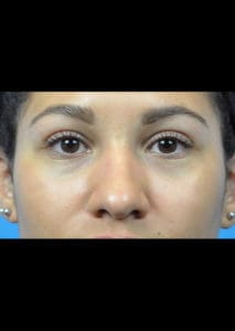 Rhinoplasty Before and After Pictures Indianapolis, IN