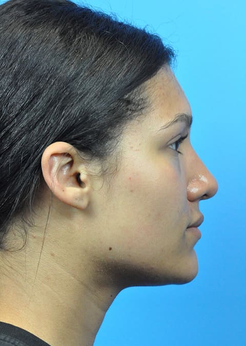Rhinoplasty Before and After Pictures Indianapolis, IN
