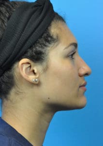 Rhinoplasty Before and After Pictures Indianapolis, IN