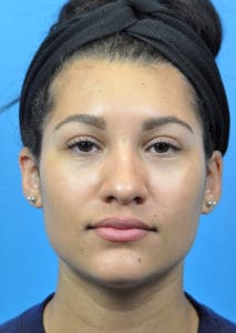 Rhinoplasty Before and After Pictures Indianapolis, IN