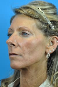 Mini Face Lift Before and After Pictures Indianapolis, IN