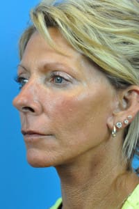 Fractional Laser Resurfacing Before and After Pictures Indianapolis, IN