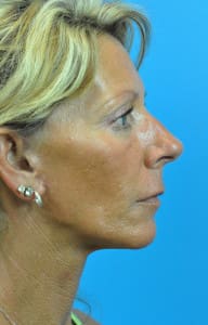 Mini Face Lift Before and After Pictures Indianapolis, IN