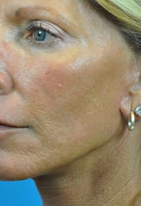 Mini Face Lift Before and After Pictures Indianapolis, IN