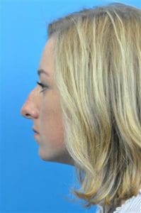Rhinoplasty Before and After Pictures Indianapolis, IN