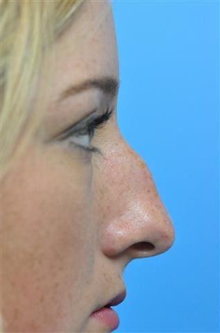 Rhinoplasty Before and After Pictures Indianapolis, IN