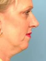 Chin Implant Before and After Pictures Indianapolis, IN