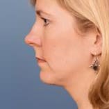 Chin Implant Before and After Pictures Indianapolis, IN
