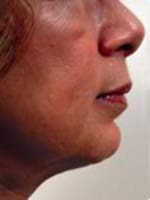Chin Implant Before and After Pictures Indianapolis, IN