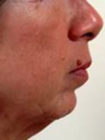 Chin Implant Before and After Pictures Indianapolis, IN