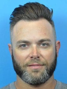Hair Transplant Before and After Pictures Indianapolis, IN