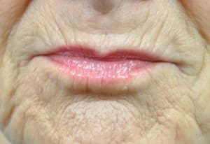 Volbella Before and After Pictures Indianapolis, IN