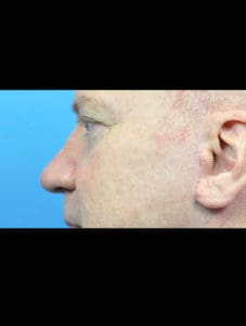 Rhinoplasty Before and After Pictures Indianapolis, IN