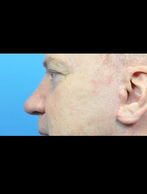 Rhinoplasty Before and After Pictures Indianapolis, IN