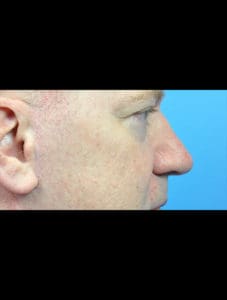 Rhinoplasty Before and After Pictures Indianapolis, IN