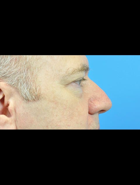 Rhinoplasty Before and After Pictures Indianapolis, IN