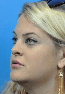 Rhinoplasty Before and After Pictures Indianapolis, IN