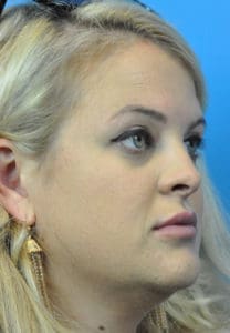 Rhinoplasty Before and After Pictures Indianapolis, IN