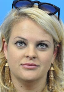 Rhinoplasty Before and After Pictures Indianapolis, IN