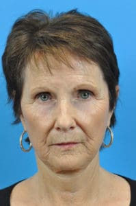 Facelift Before and After Pictures Indianapolis, IN