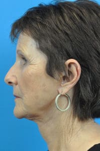 Facelift Before and After Pictures Indianapolis, IN