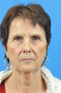 Facelift Before and After Pictures Indianapolis, IN