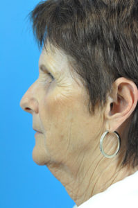 Facelift Before and After Pictures Indianapolis, IN