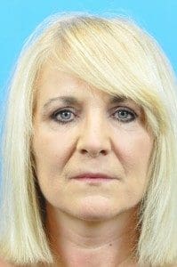 Volbella Before and After Pictures Indianapolis, IN