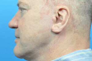 Blepharoplasty Before and After Pictures Indianapolis, IN