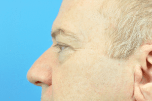 Blepharoplasty Before and After Pictures Indianapolis, IN