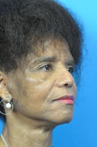 Facelift Before and After Pictures Indianapolis, IN