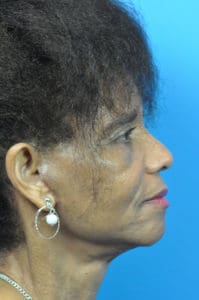 Facelift Before and After Pictures Indianapolis, IN